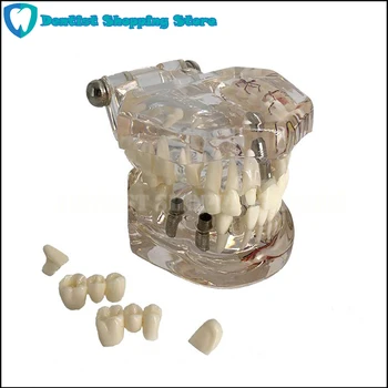 Dantų dantų modelio Skaidrios patologinių implantas nervų modelis Remonto modelio Mokymo demonstravimo modelis