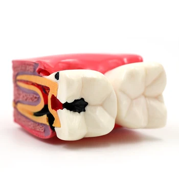 6 Kartus Ėduonies Dantų Comparsion Modelis Dantų Studijų Mokymo ir Tiria, kaip Anatomija Švietimo Dantų Modelis