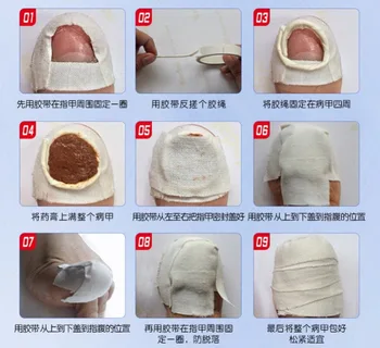 Kinų Medicinoje Žolės Kojų Nagų Grybelio Gydymas Anti Grybelinių Nagų Infekcijų Essence Nagų Gydymas, Šalinimas, Nagų Priežiūros Losjonas